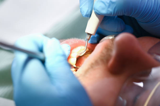Best Emergency Dentist for Lost Fillings or Crowns in Hamilton, TX
