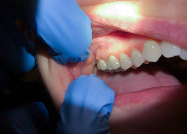 Best Emergency Dental Care for Abscessed Tooth in Hamilton, TX